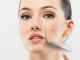 7 trucuri care te ajută în lupta împotriva acneei