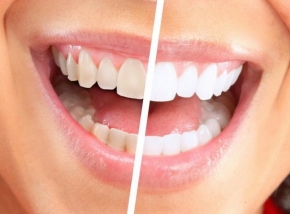 Sfaturi simple pentru a preveni îngălbenirea dinților